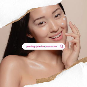 PEELING PARA ACNE
