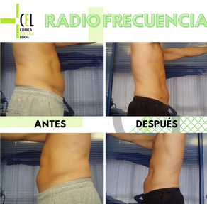 RADIOFRECUENCIA 