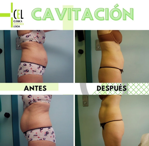 LA CAVITACIÓN 10 SESIONES