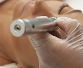 TRATAMIENTO FACIAL PROFESIONAL CON DERMAPEN